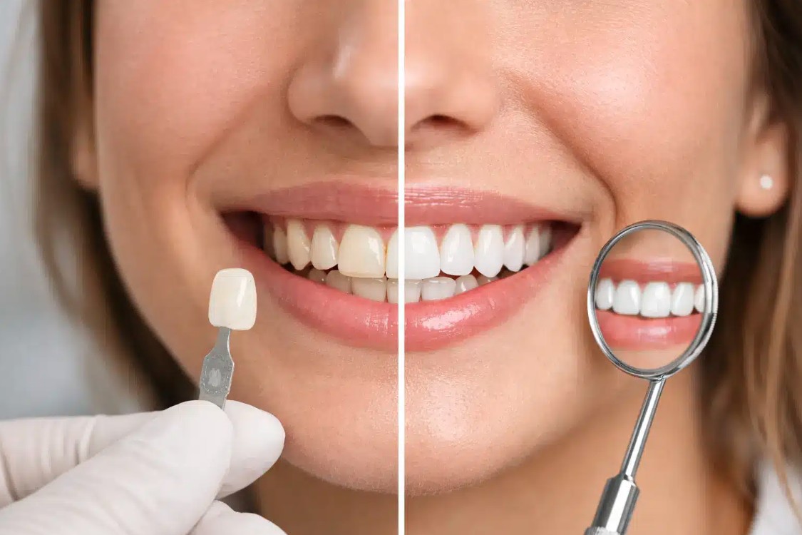 Carillas dentales: todo lo que debes saber antes de decidir